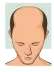 Stage 1 : Hair fall solution
