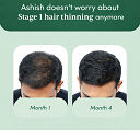 Stage 1 : Hair fall solution