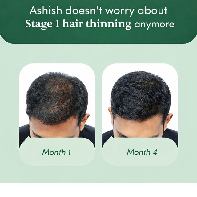 Stage 1 : Hair fall solution